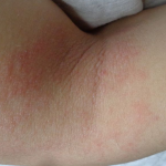 Imágen de dermatitis atópica